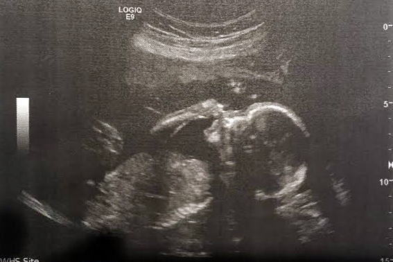 ultrasound picking nose at 20 weeks 4 days ultrasound